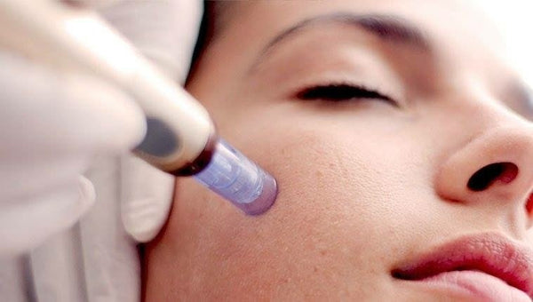 Closeup of woman’s face being treated with a microneedling pen for collagen induction therapy 