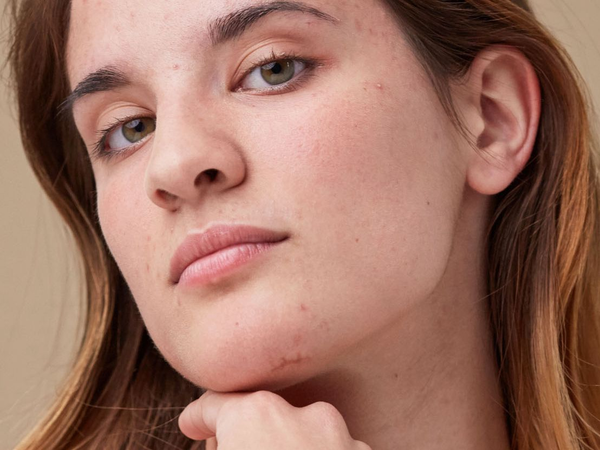 Woman’s clean makeup free face with small acne scars